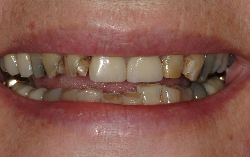Full Mouth Rehabilitation - Case 2 - Before Treatment