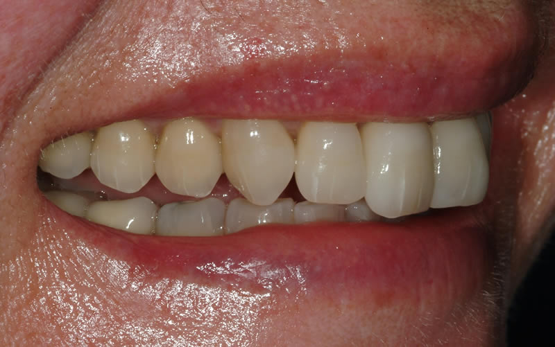 Full Mouth Rehabilitation - Case 2 - After Treatment