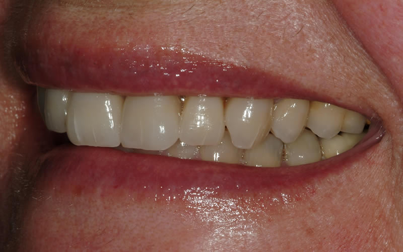 Full Mouth Rehabilitation - Case 2 - After Treatment