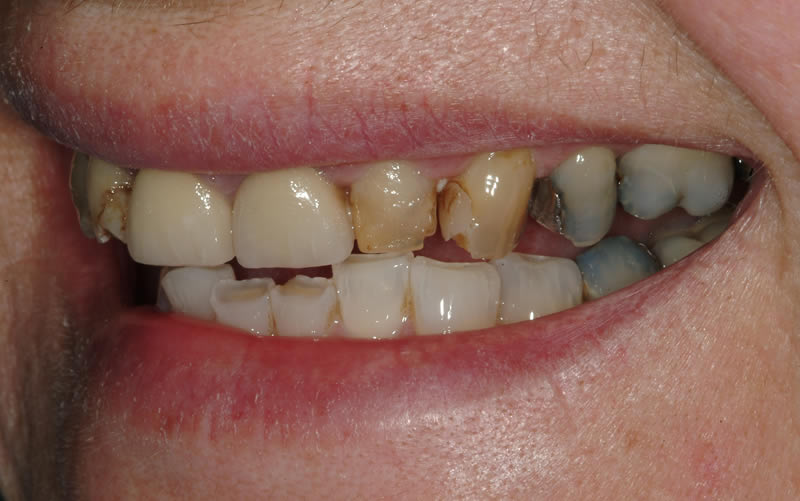 Full Mouth Rehabilitation - Case 2 - After Treatment