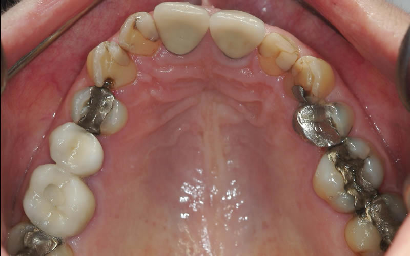 Full Mouth Rehabilitation - Case 2 - Before Treatment