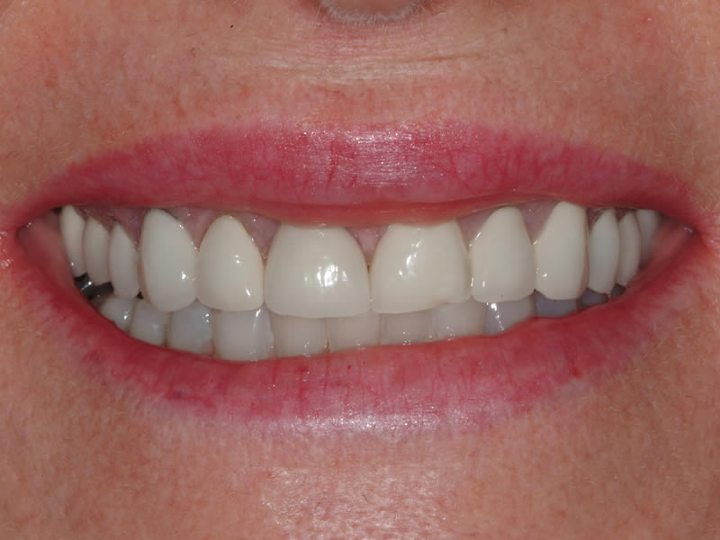 Full Mouth Rehabilitation - Case 3 - Before Treatment