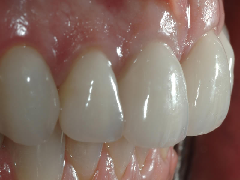Full Mouth Rehabilitation - Case 3 - After Treatment