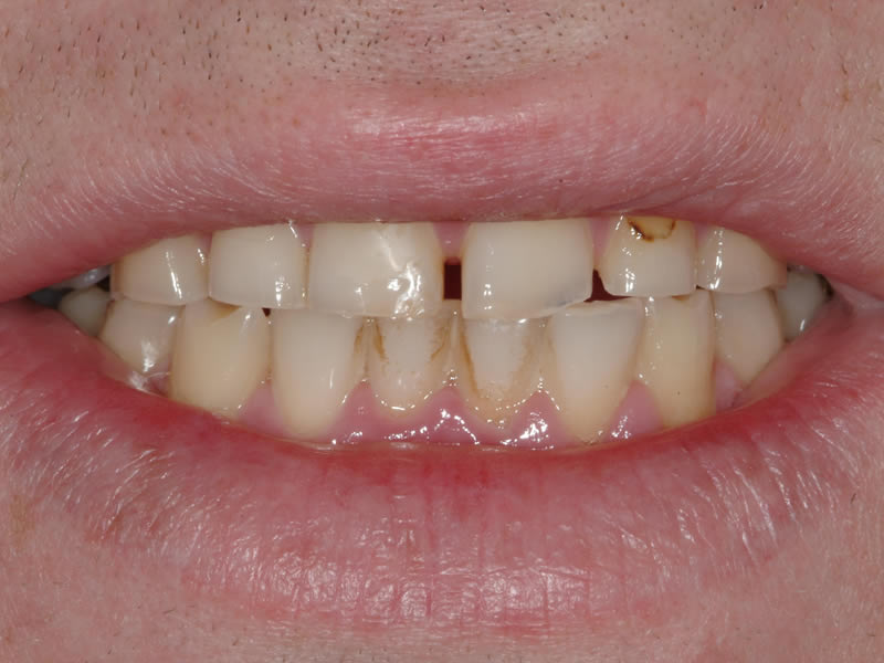 Full Mouth Rehabilitation - Case 4 - Before Treatment
