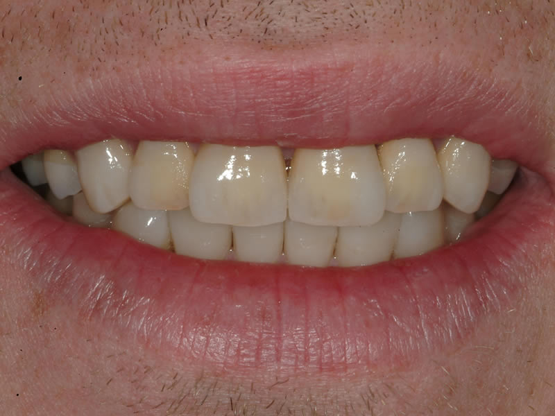 Full Mouth Rehabilitation - Case 4 - After Treatment