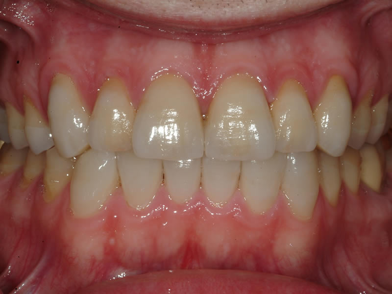 Full Mouth Rehabilitation - Case 4 - After Treatment