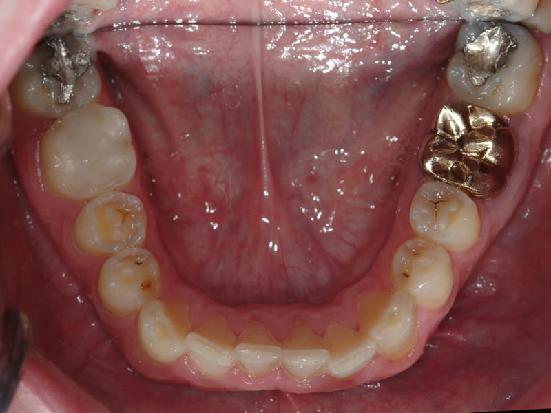 Full Mouth Rehabilitation - Case 4 - Before Treatment