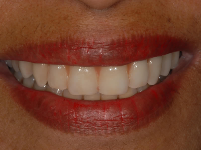 Full Mouth Rehabilitation - Case 5 - After Treatment