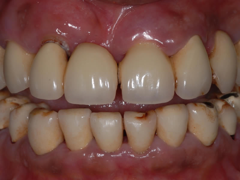 Full Mouth Rehabilitation - Case 5 - Before Treatment