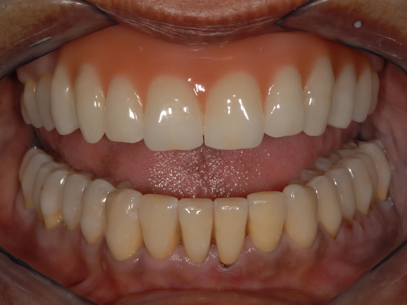 Full Mouth Rehabilitation - Case 5 - After Treatment
