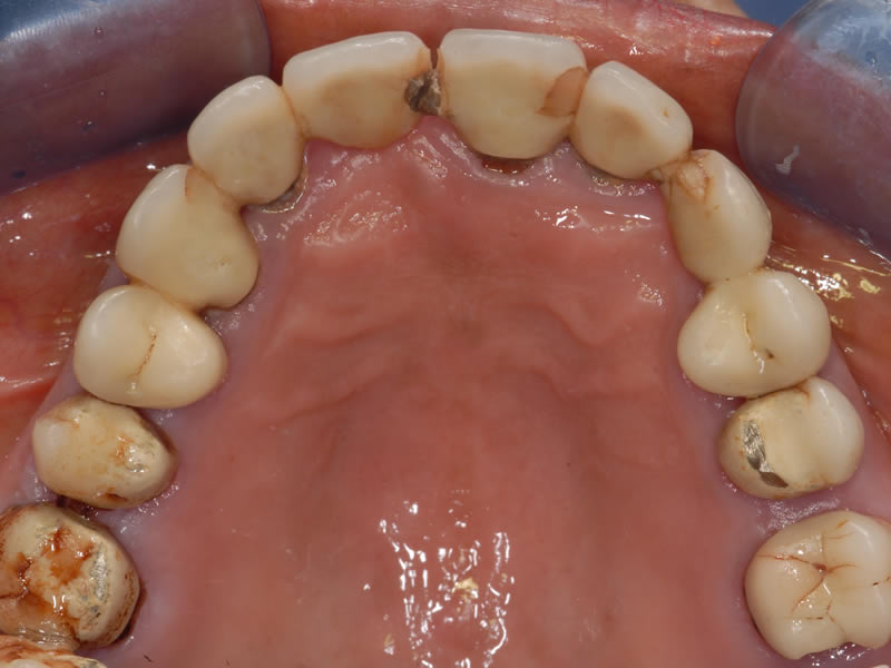 Full Mouth Rehabilitation - Case 5 - Before Treatment