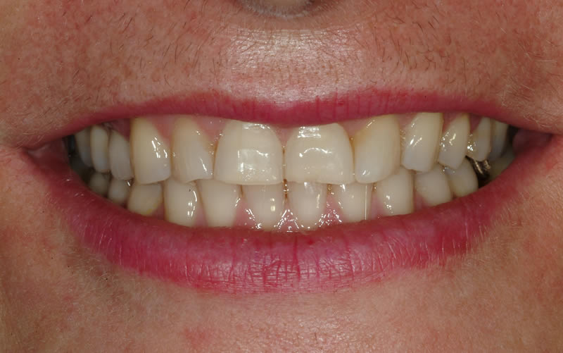 Worn Teeth Case 1  - Before Treatment